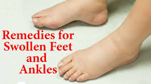 10 natural remes for swollen feet