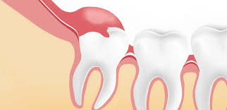 The cost of removing wisdom teeth with soft tissue impact ranges from $200 to $400. Wisdom Teeth Removal Cost In Sydney And Melbourne Wisdom Dental Emergency