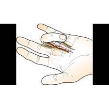 Открытая лигаментотомия при стенозирующем лигаментите («щелкающем пальце»)  - «Открытая лигаментотомия при стенозирующем лигаментите («щелкающем  пальце»). Операция в Центре амбулаторной хирургии кисти» | отзывы