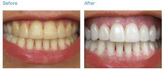 teeth whitening aurora dental group