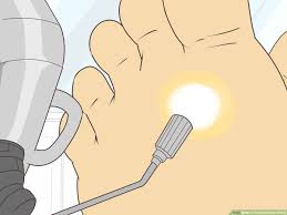 how to freeze plantar warts wikihow