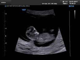 Ssw sieht dein baby im ultraschall schon richtig menschlich aus. 10 Woche Wireltern Ch
