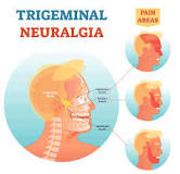 Image result for icd 10 cm code for trigeminal neuralgia