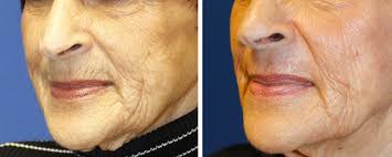 upper lip wrinkles with dermabrasion