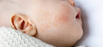 baby acne why do newborns get pimples