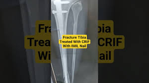 fracture tibia treated with crif with