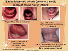 checking for tongue lip ties