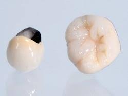 Dolomite Dental Pfm Crown