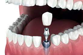 implant dentar cu tehnologie de ultima