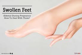 swollen feet edema during pregnancy