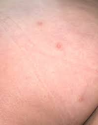 Does hsv2 first outbreak may look like a normal rash, or ulcers (or blisters, or papules) are seen from the begining of the outbreak itching starts? answered by dr. Pimple Boil Or Herpes On Buttocks Genital Herpes Simplex Forums Patient