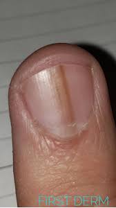 common nail discoloration first derm