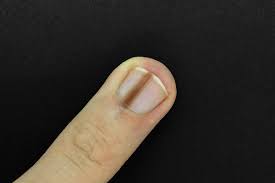 brown line on nails vitamin