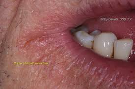 angular cheilitis is the gross mouth