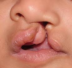 kekurangan asid folik folate cleft lip palate bibir lelangit terbelah