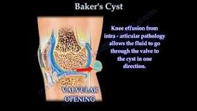 Image result for icd 10 code for left baker's cyst