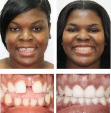 Gap between teeth fixed with invisalign. Invisalign Harrisburg Hd Ortho