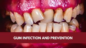 gum infection and prevention