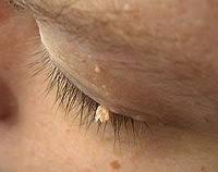 icd 10 papilloma of eyelid r human