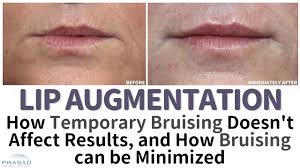bruising occur after lip augmentation