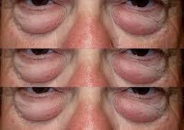what causes dermatochalasis baggy eyes