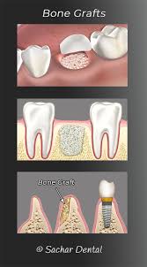 Jul 22, 2021 · dental insurance for implants may cover some or all of the associated costs. Dental Bone Graft Nyc Manhattan Dental Implant And Bone Graft