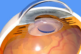 cataract lens implants premium vs