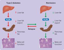 2 diabetes remission