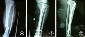 distal tibia extra articular fractures