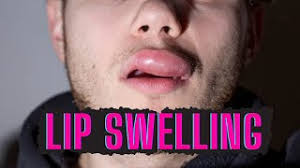 causes of swollen lips and how to treat