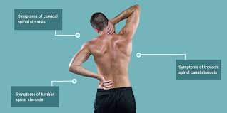 spinal stenosis symptoms risk factors