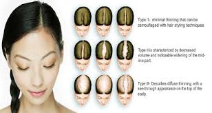 Notable hair loss/thinning onset within the past five years. Low Level Laser Therapy In Singapore Effective Hair Loss Treatment