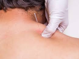Dry Needling Vs Acupuncture Benefits And Uses
