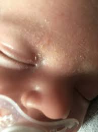 dry skin around baby s eyes babycentre