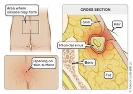 Laser hair removal since its inception, laser hair removal has been used mainly for aesthetic purposes. Pilonidal Sinus
