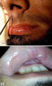 midline con upper lip sinus a