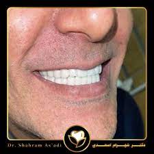 کاشت ایمپلنت دندان - فیلم ایمپلنت دندان - عوارض ایمپلنت دندان - ایمپلنت دندان چقدر طول میکشد