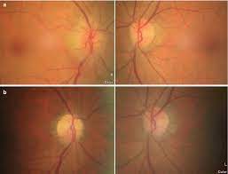 Anterior ischemic optic neuropathy (aion) is a medical condition involving loss of vision due to damage to the optic nerve from insufficient blood supply. Non Arteritic Anterior Ischemic Optic Neuropathy Naion Springerlink