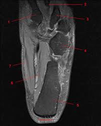 Foot ulceration can subsequently lead to infections, such as cellulitis and osteomyelitis, and this may eventually the mri examination includes special attention for positioning of the foot. Mri Of The Ankle Detailed Anatomy W Radiology