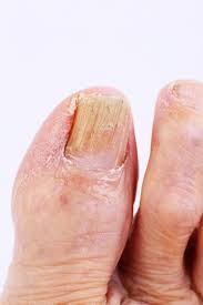 toenail discoloration treatments for