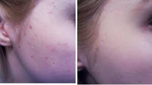 acne scars with k beauty