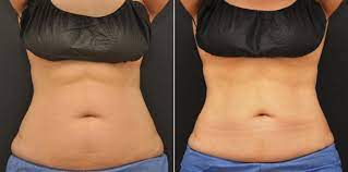 how much does coolsculpting elite cost