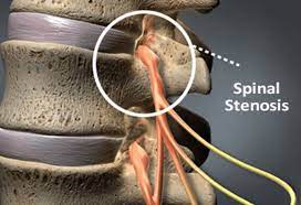 spinal stenosis symptoms bonati spine