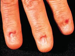 nail disorders springerlink