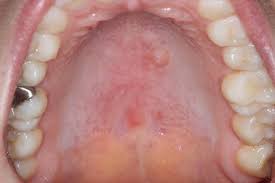 mucosal malignancies springerlink