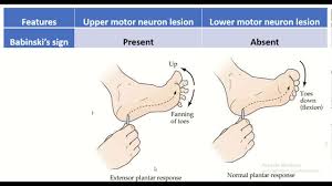 lower motor neuron lesion