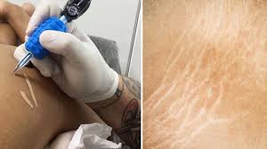 stretch mark scar vigo tattoo