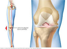 Do knee braces help with knee pain?