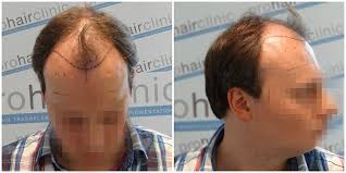Regrowth Phase After A Hair Transplantation Prohair Clinic