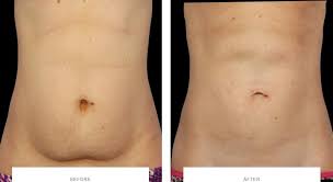 lose belly fat with coolsculpting